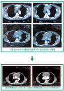 肿瘤诊疗中心纵膈肿瘤放化疗案例